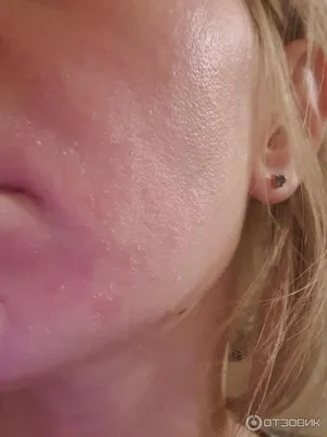 Отзыв о Кислородная косметика Faberlic | Ужасная аллергия и зуд после  косметики # Faberlic !