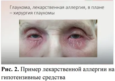 Аллергия на косметику: как избежать проблем - Лента новостей Барнаула