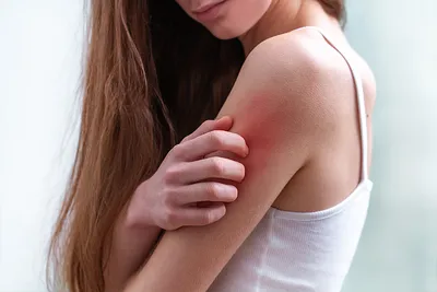 Аллергия на коже: симптомы и причины | Диагностика и лечение кожной аллергии  в АО «Медицина»