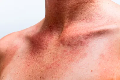 Аллергическая сыпь на теле: причины, симптомы, лечение и профилактика