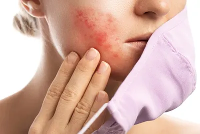 Аллергические заболевания кожи
