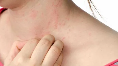 Аллергия на антибиотики: сыпь на коже - симптомы, причины и лечение