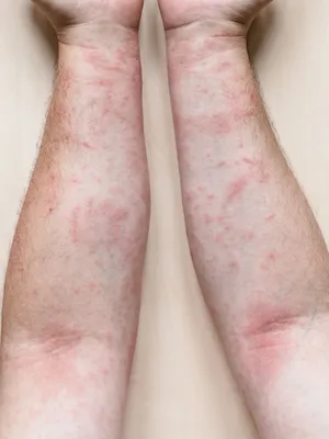 Прыщи аллергии на коже ребенка. Пищевая аллергия Стоковое Фото -  изображение насчитывающей кожа, природа: 203529070