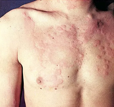Первые признаки аллергии: симптомы, диагностика, лечение первых признаков  аллергии - Аллергология и иммунология – Государственная больница НКЦ №2  (ЦКБ РАН)