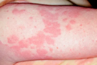 Аллергия на коже - красные пятна чешутся, лечение (фото) | Анютины глазки,  Пятна, Кожа