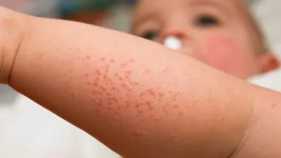 У ребёнка сыпь по всему телу. Куда бежать – к аллергологу, педиатру или  кожнику? | Новости Таджикистана ASIA-Plus