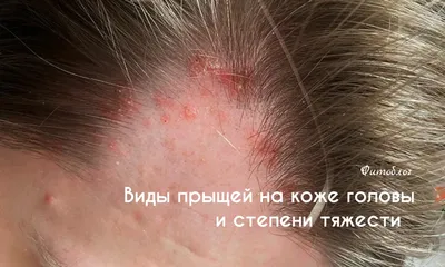 Аллергия на коже головы фото фото