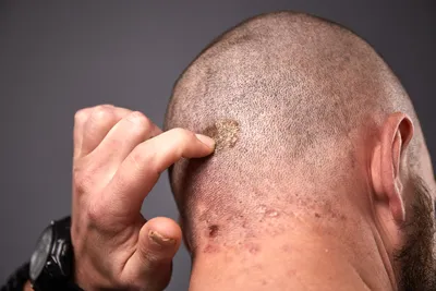 Гнойники на коже головы в волосах – причины и лечение