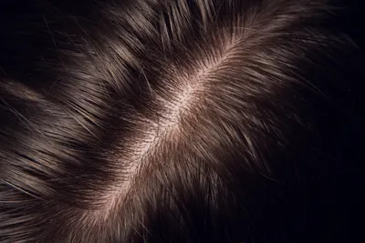 Как обнаружить грибок кожи головы и проводить его лечение