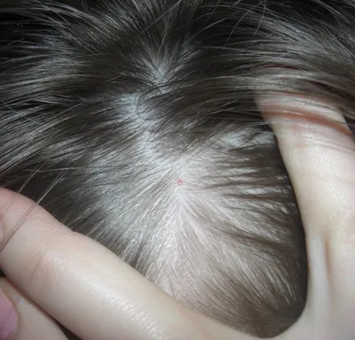 Дерматологическое кожное заболевание. Аллергия дерматита экземы псориазе.  Wan повреждения кожи головы Стоковое Фото - изображение насчитывающей  эпидермис, рука: 156141456