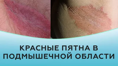 Как лечить болячки в волосах на коже головы | Блог IHC Clinic