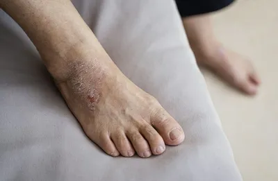 Аллергия на коже ног фото фото
