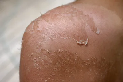 Дерматолог рассказала, как защитить кожу при аллергии на солнце