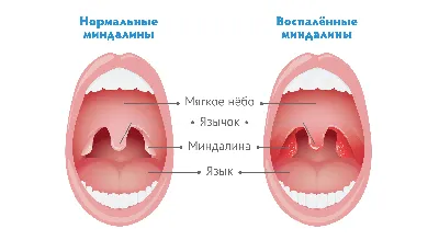 Почему чешется небо во рту