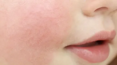 Аллергия у детей | Семья | WB Guru