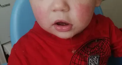 Аллергия у ребёнка — 11 ответов | форум Babyblog