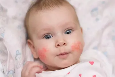 Внимание: аллергия на морепродукты у младенца! — Московское общество  детских врачей