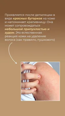 Лазерная Эпиляция / LPG массаж Иркутск on Instagram: \"Возможна ли аллергия  на лазерную эпиляцию⁉️ Бывают случаи, после лазерной эпиляции встречается  покраснение кожи, сыпь в виде крапивницы и зуд. Откуда такая реакция? Есть