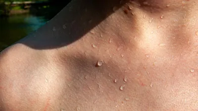 солнце сыпи аллергии стоковое изображение. изображение насчитывающей  микстура - 14962727