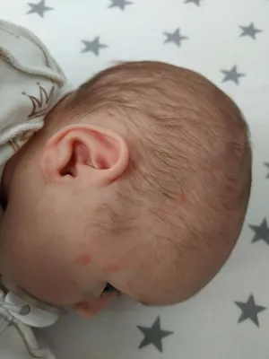 Редкий и жидкий стул у новорожденного и цветение или всё-таки аллергия... —  2 ответов | форум Babyblog