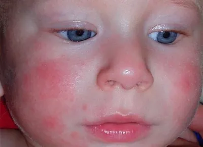 Аллергия на холод - Zakład Opieki Zdrowotnej «Grodzieńska Klinika  Uniwersytecka»