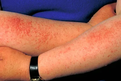 Женщина, живущая с аллергией на воду - Hi-News.ru