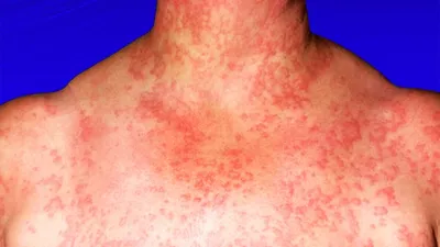 Аллергия на воду из под крана симптомы фото фото
