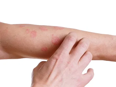 Аллергия: симптомы у взрослых, признаки, как проявляется, причины, лечение