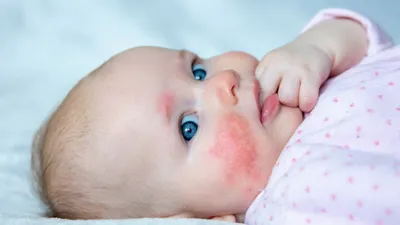 Помогите! Аллергия (крапивница) у ребёнка. Пищевая или на стиральный  порошок Ушастый нянь? — 20 ответов | форум Babyblog