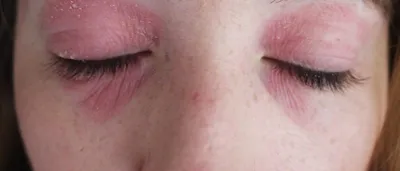 Средства для лечения аллергии Фармак Лоратадин - «Спасти косметического  маньяка... Лоратадин как SOS-средство при аллергии на патчи для кожи вокруг  глаз» | отзывы