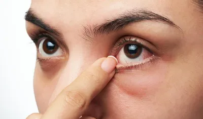 Крем-гель для кожи вокруг глаз Чистая линия \"Ромашка и петрушка\" - «Вызвал  аллергическую сыпь. Я вообще не аллергик (фото результата прилагаются)» |  отзывы