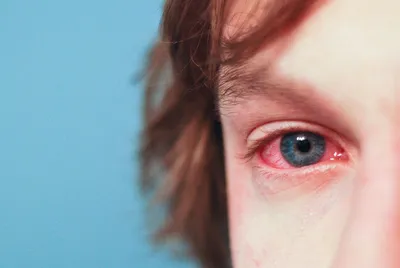 Ужасная аллергия на крем вокруг глаз от L'oreal! | Sensi🌿 | Дзен