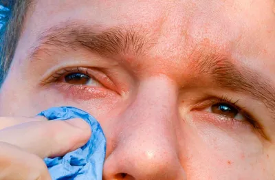 Аллергия вокруг глаз: причины симптомы лечение - Вижу супер