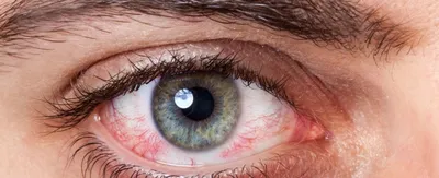 Крем для кожи вокруг глаз L'Oreal Paris Revitalift Лазер х3 - «Аллергия на  этот чудо-крем. Смотрите фото» | отзывы