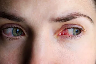 Причины аллергии на глазах «Ochkov.net»