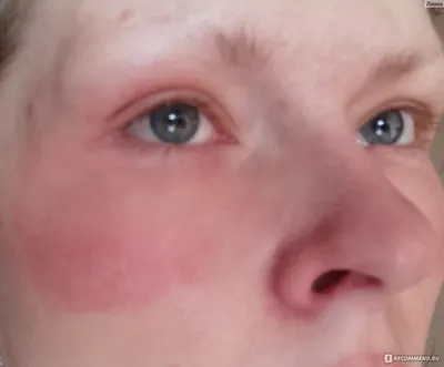Аллергия вокруг глаз фото фото