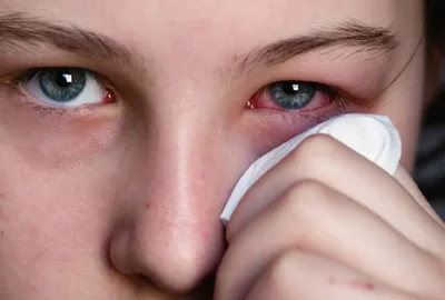 Сухая кожа вокруг глаз: 5 причин и что делать с сухостью