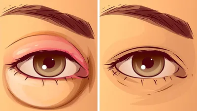 Аллергия на глазах: причины, симптомы, как выглядит, чем лечить :: SYL.ru
