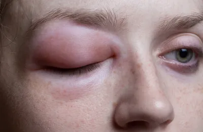 аллергия на косметику. девушка смотрит на прыщи вокруг глаз, которые  появились после использования токсичной косметики. красные пя Стоковое Фото  - изображение насчитывающей дерматология, дерматит: 248186908