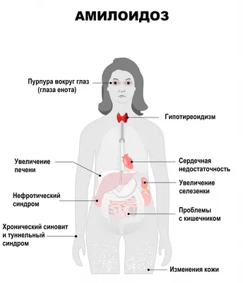 Семейная средиземноморская лихорадка. Клиническая картина, критерии,  диагностика.