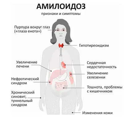 Амилоидоз - презентация онлайн