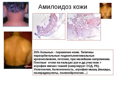 Амилоидоз – тема научной статьи по ветеринарным наукам читайте бесплатно  текст научно-исследовательской работы в электронной библиотеке КиберЛенинка