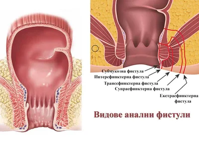 Анална фистула – видове анални фистули (класификация) | ArsMedica.bg