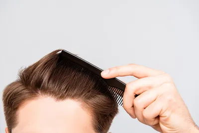 Выпадение волос (алопеция): что это, симптомы и лечение | Статьи МедЭксперт