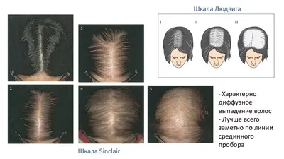 Лечение алопеции в СПб - андрогенная алопеция у женщин и мужчин