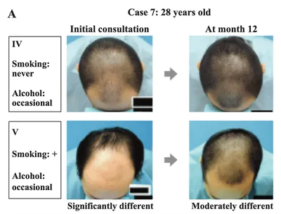 Андрогенетическая алопеция – наиболее распространенная форма выпадения  волос у мужчин и женщин. Главный принцип лечения АГА – комплексный… |  Instagram