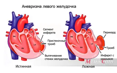 Аневризма сердца: симптомы, диагностика, лечение. Осложнения аневризмы  сердца