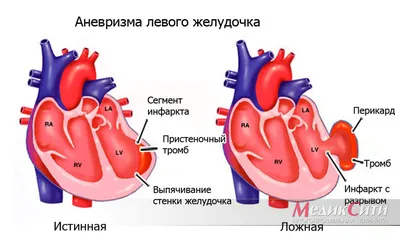 Аневризма сердца фото фото