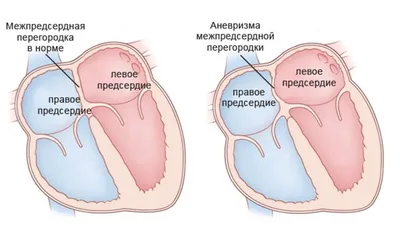 Аневризма сердца, лечение и диагностика в Ростове-на-Дону