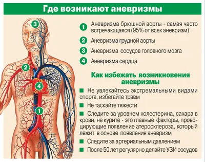 Аневризма аорты: причины, симптомы, диагностика и лечение